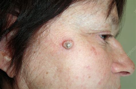 Symptoms Of Skin Cancer On Face