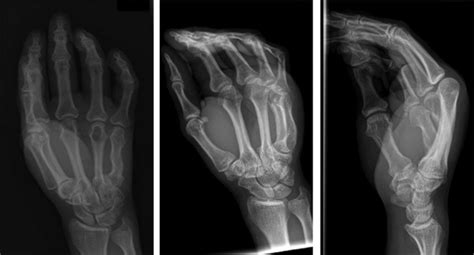 Right Hand X Ray Posterior Anterior Pa Oblique Lateral
