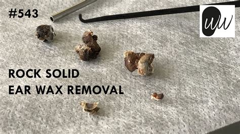 543 Rock Solid Ear Wax Removal Youtube
