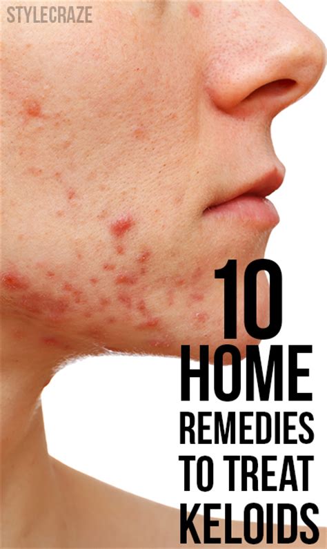 Top 12 Effective Home Remedies To Treat Keloids