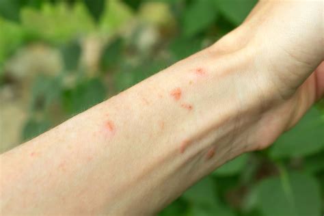 Plants That Cause Rashes Identification And Treatment