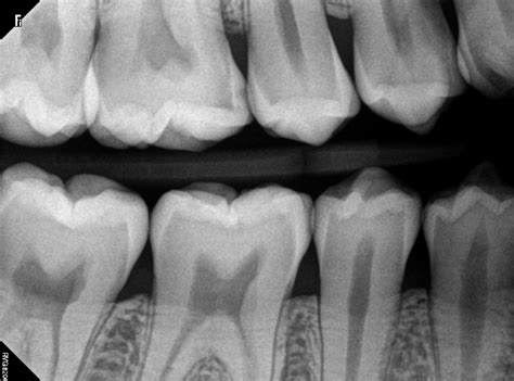 What Does A Cavity Look Like On An X Ray Web Dmd