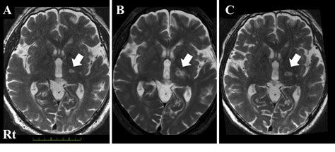 Figure 2 From Magnetic Resonance Imaging Guided Focused Ultrasound