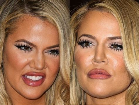 Pin On Plastic Surgery Before After