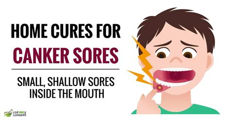 10 Best Home Remedies For Canker Sores Canker Sore Cankers Soreness