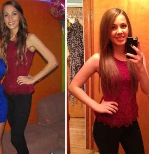 120 Before And After Pics Of People Who Defeated Anorexia Bored Panda