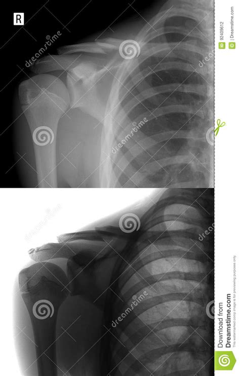 X Ray Of The Right Collarbone Fracture Of Clavicle Stock Photo