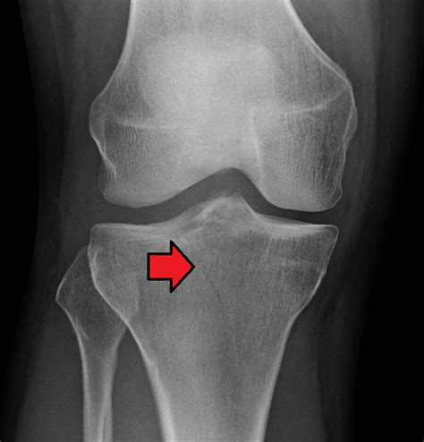 Fracture Of The Proximal Tibia