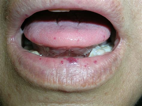 Hereditary Hemorrhagic Telangiectasia Tongue
