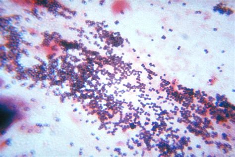 Public Domain Picture This Sputum Smear Shows Staphylococcus Bacteria