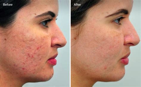 Laser Skin Resurfacing For Acne Scars Does It Work Before And Afters