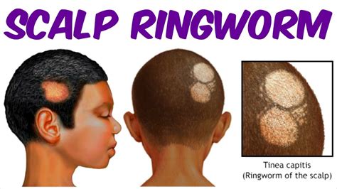 Scalp Ringworm A Tinea Capitis Infection Youtube