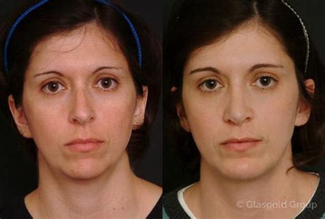 Neck Liposuction Princeton Nj Patient 26585