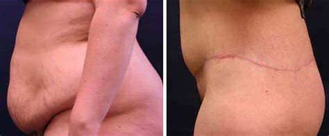 Check spelling or type a new query. Chicago tummy tuck pictures & abdominoplasty surgery