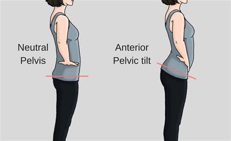 female anterior pelvic tilt