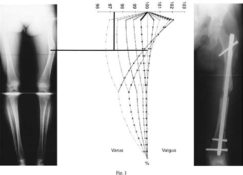 Figure 1 From Malunion In The Lower Limb A Nomogram To Predict The