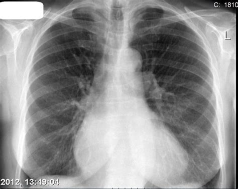 An X Ray Shows The Chest And Lungs