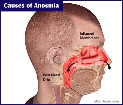 Anosmia (the inability to smell) and hyposmia (a decreased ability to smell) describe the range of olfactory dysfunction, or smell disorders. Anosmia: What Causes Loss of Smell & What is its Treatment?