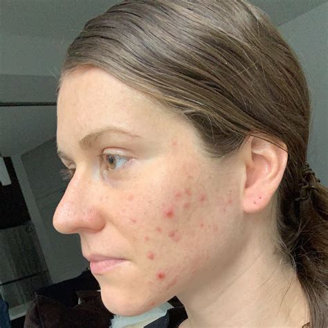 Hormonal Cystic Acne The Root Cause And 5 Steps To Treat It — Plant
