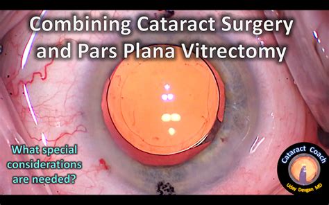 Cataract Surgery And Pars Plana Vitrectomy Cataract Coach