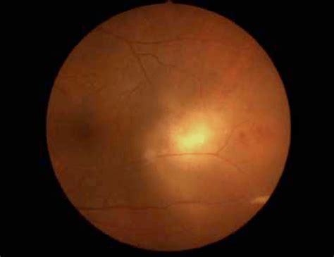 Fundus Photograghy Shows Exudative Retinal Detachment Retinal