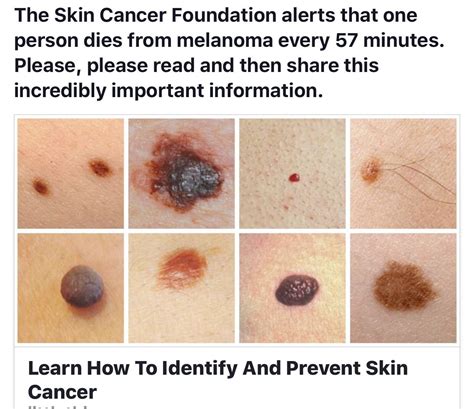 Skin Cancer Moles Signs