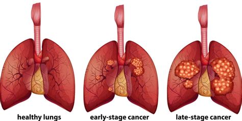 Staging Of Lung Cancer Lung Cancer Stages