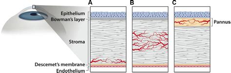 E Three Common Corneal Neovascularization Nv Morphologies Are A Deep