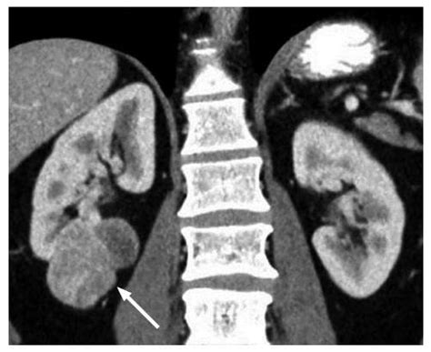 Review Of Renal Cell Carcinoma And Its Common Subtypes In Radiology