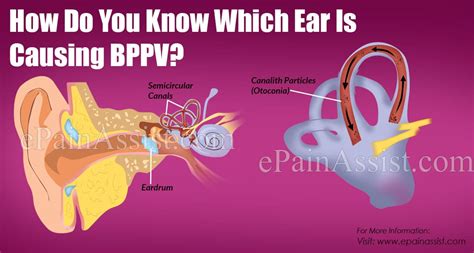 How Do You Know Which Ear Is Causing Bppv