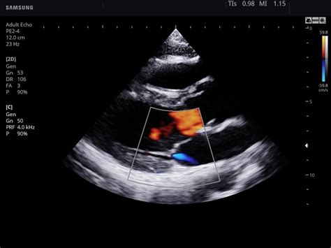 Ultrasound Images Heart Color Doppler Echogramm №770