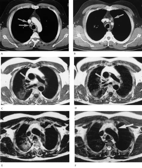 Pet Ct And Mri With Combidex For Mediastinal Staging In Non Small