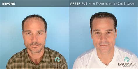 Smartgraft Fue Hair Transplant Results From Dr Alan Bauman · Bauman