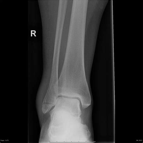 Weber A Ankle Fracture Radiology Case