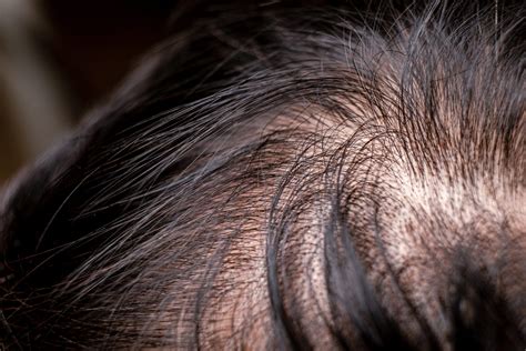 Trockene Kopfhaut Haarausfall Zusammenhang And Behandlung Badefrohde