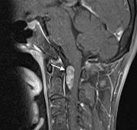 Neurenteric Cyst Presented With Progressive Head And Neck Pain The