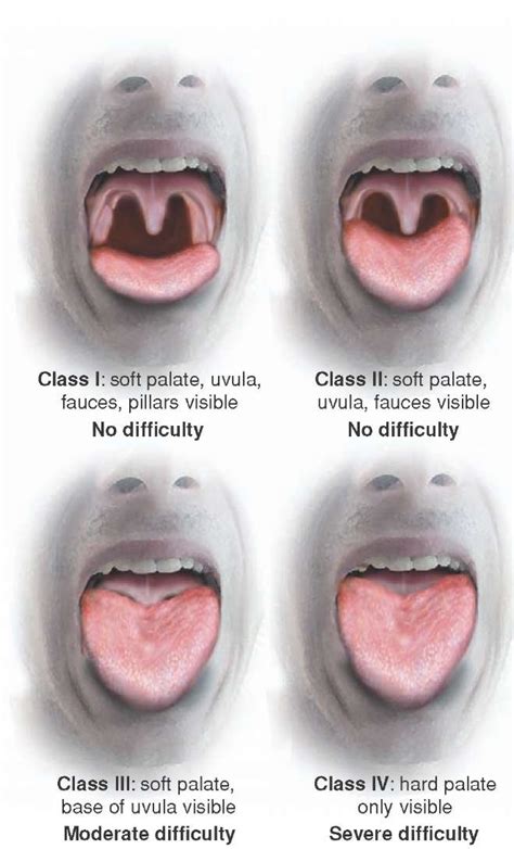 Intubating Airway Management (Clinical Essentials) (Paramedic Care) Part 4