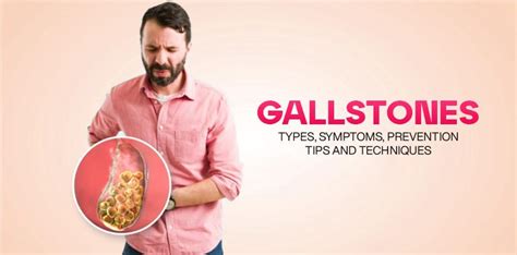Gallstones Types Symptoms Prevention Tips And Techniques