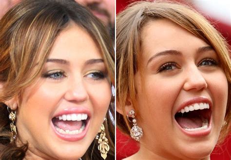 Miley Cyrus Dental Treatment