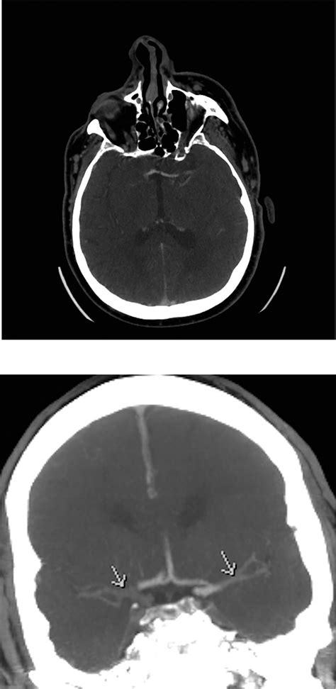 Bilateral Middle Cerebral Artery M1 Segment Occlusion Axial A And