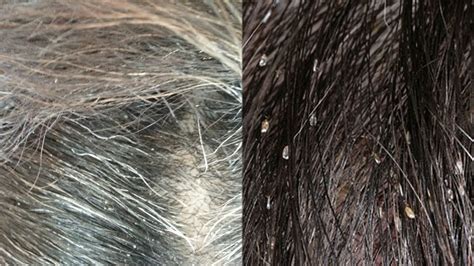 How Can I Tell If I Have Head Lice Or Dandruff Youtube