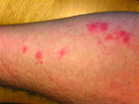 What Do Bed Bug Bites Look Like Abc Blog