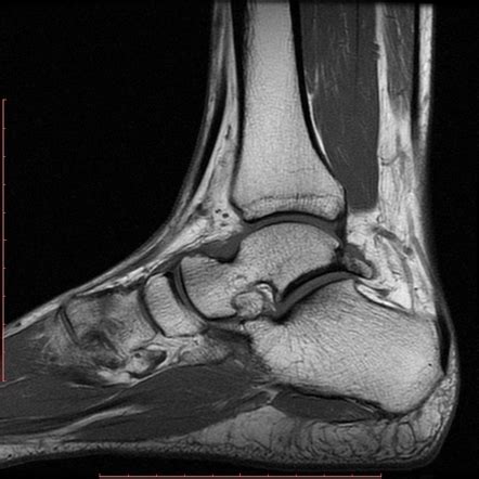 Mri Posterior Ankle Impingement A Sagittal T Weighted Image The Best Porn Website