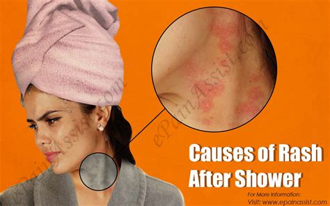 Causes Of Rash After Shower Picture
