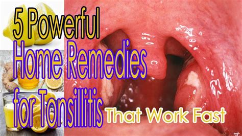 5 Powerful Home Remedies For Tonsillitis That Work Fast Youtube