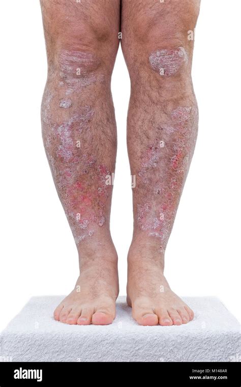 Le psoriasis est une maladie inflammatoire chronique de la peau détails des jambes Photo Stock