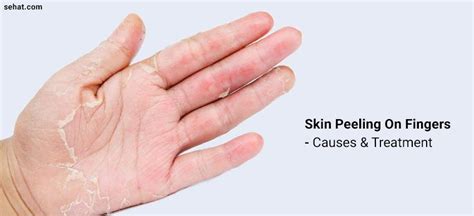 Peeling Skin On Fingers Near Nails Core Plastic Surgery