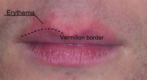 Quest For Health Lip Lickers Dermatitis Aka Chapped Lips