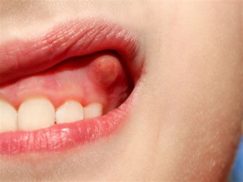 Oral Fibroma Removal In Ahwatukee Phoenix Az Atrium Dental