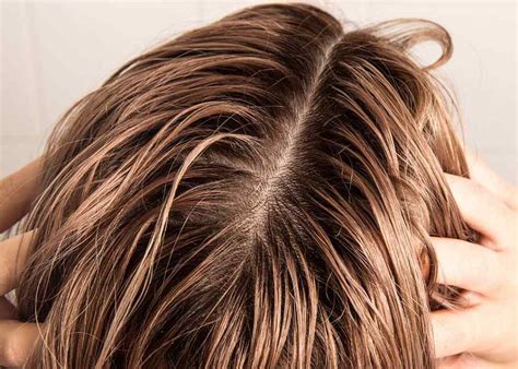 5 Natural Remedies For Oily Hair Mscape